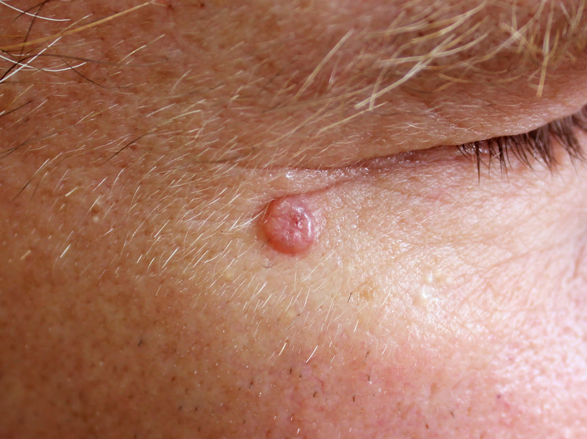 Pearly basal cell carcinoma with visible blood vessels on sun-damaged skin