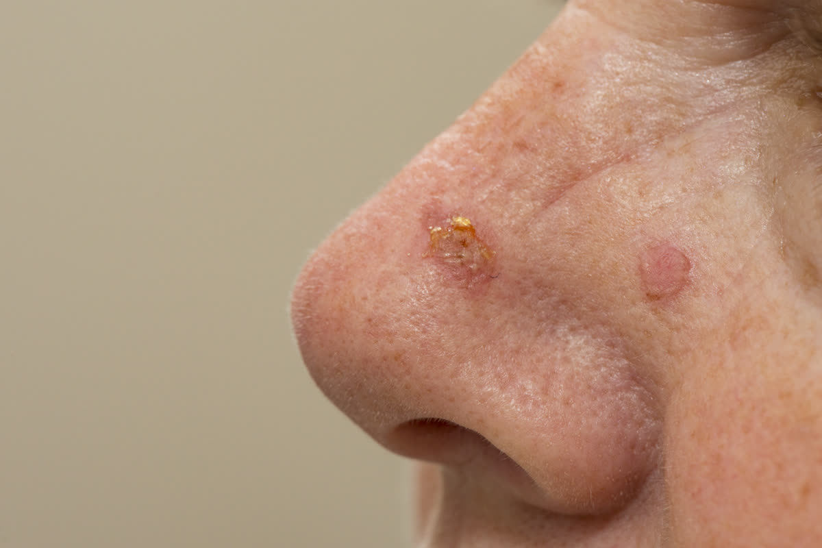 Scaly, crusted squamous cell carcinoma on sun-exposed skin