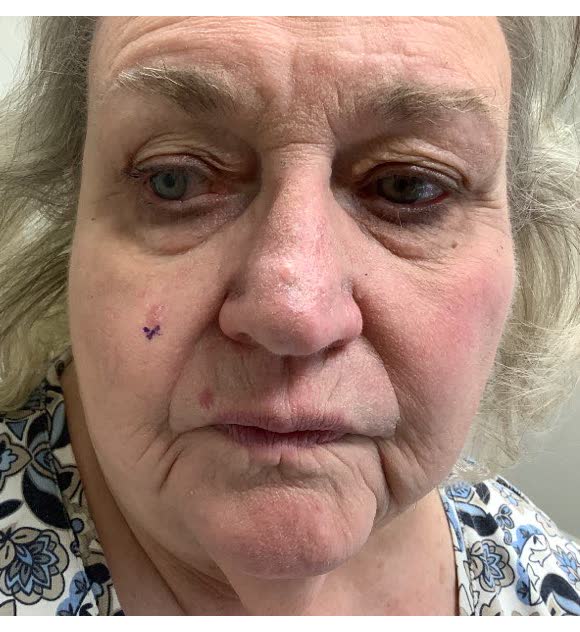 Mohs case 1 — Before: basal cell carcinoma on the right cheek