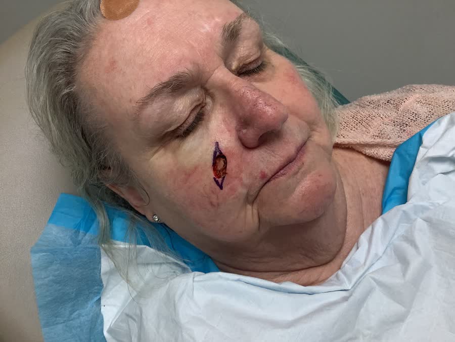 Mohs case 1 — After cancer removal: basal cell carcinoma on the right cheek