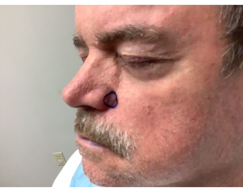 Mohs case 2 — Before: basal cell carcinoma involving the cheek and nose