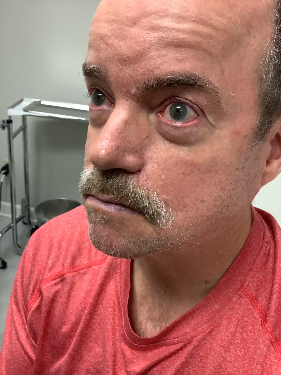 Mohs case 2 — Healed: basal cell carcinoma involving the cheek and nose