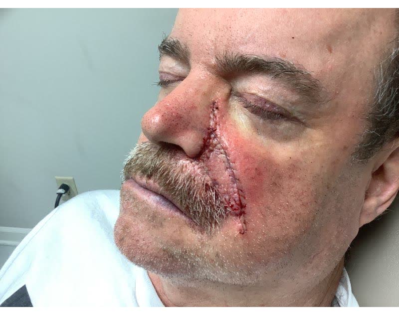 Mohs case 2 — Repair · same day: basal cell carcinoma involving the cheek and nose