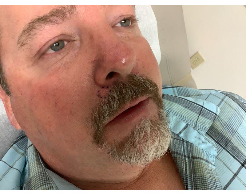 Mohs case 3 — Before: basal cell carcinoma on the right upper lip