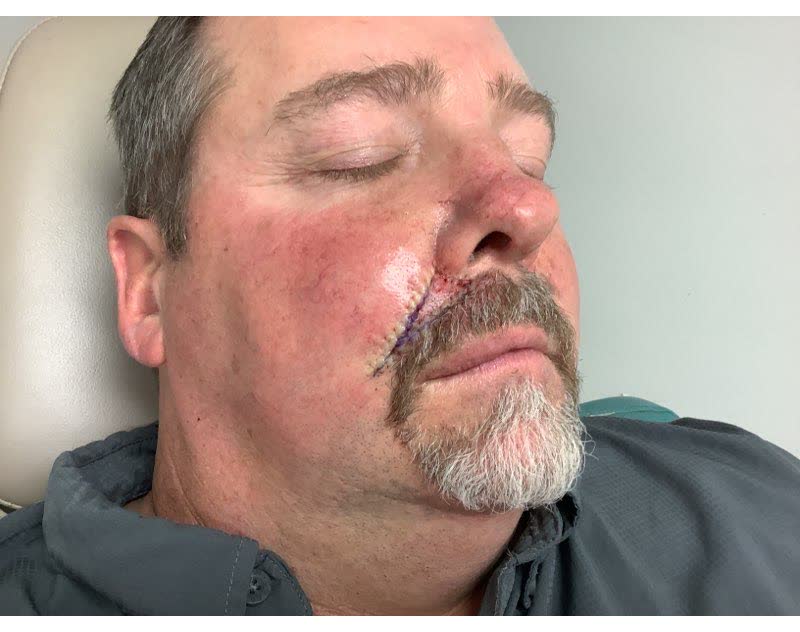 Mohs case 3 — Repair · same day: basal cell carcinoma on the right upper lip