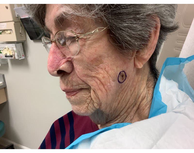 Mohs case 4 — Before: squamous cell carcinoma on the left cheek