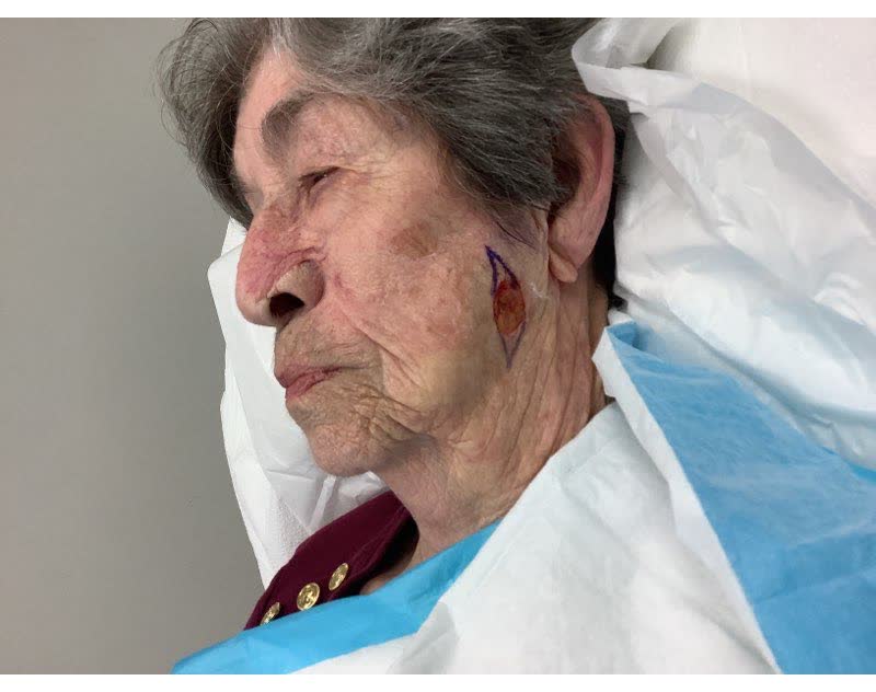 Mohs case 4 — After cancer removal: squamous cell carcinoma on the left cheek