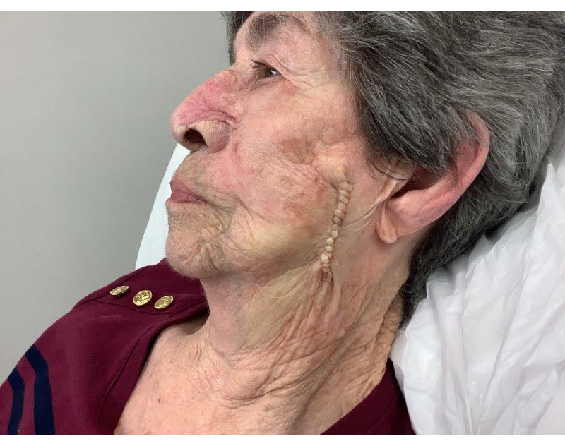 Mohs case 4 — Repair · same day: squamous cell carcinoma on the left cheek