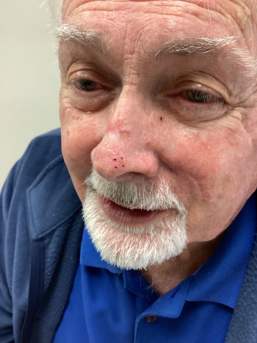 Mohs case 5 — Before: basal cell carcinoma on the nasal supratip