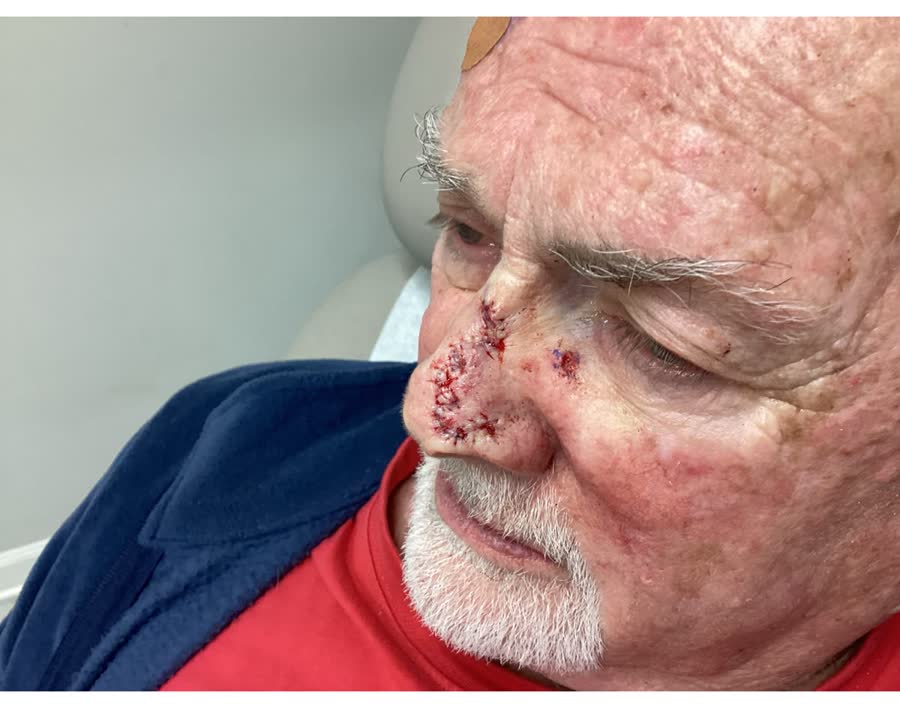Mohs case 5 — Repair · same day: basal cell carcinoma on the nasal supratip