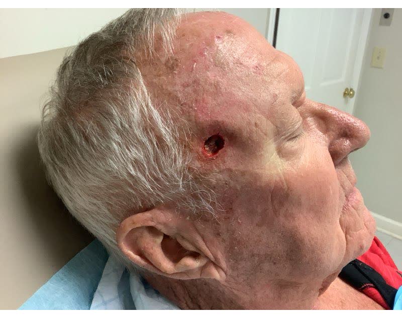 Mohs case 6 — After cancer removal: squamous cell carcinoma on the right forehead