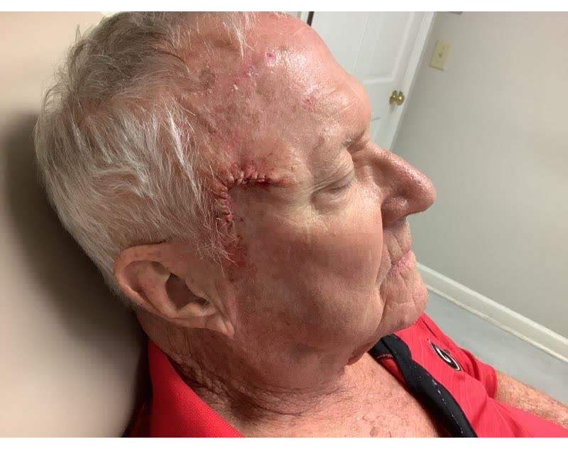 Mohs case 6 — Repair · same day: squamous cell carcinoma on the right forehead