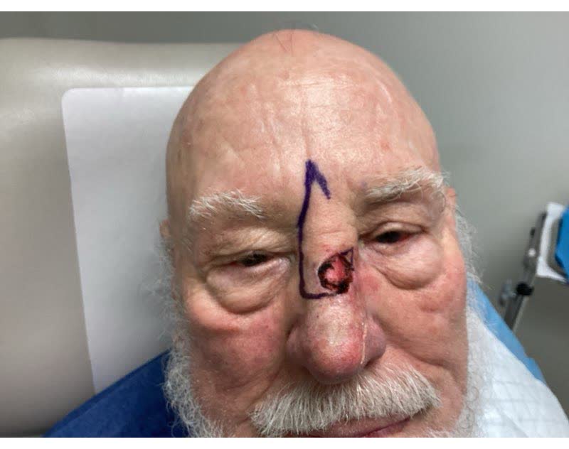 Mohs case 7 — After cancer removal: squamous cell carcinoma on the nose