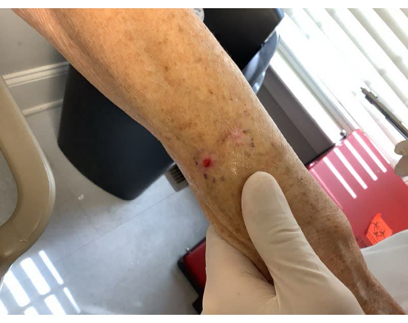 Mohs case 8 — Before: two infiltrative basal cell carcinomas on the left forearm