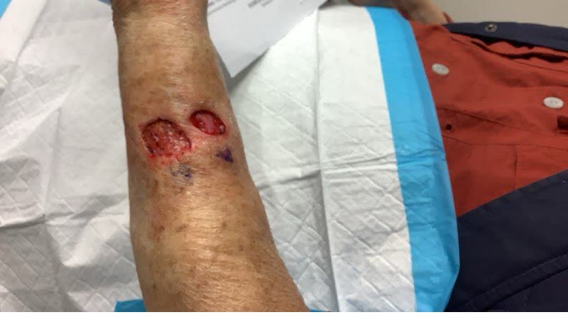 Mohs case 8 — After cancer removal: two infiltrative basal cell carcinomas on the left forearm