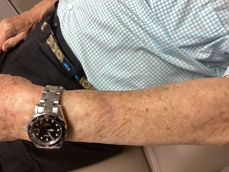 Mohs case 8 — Healed: two infiltrative basal cell carcinomas on the left forearm
