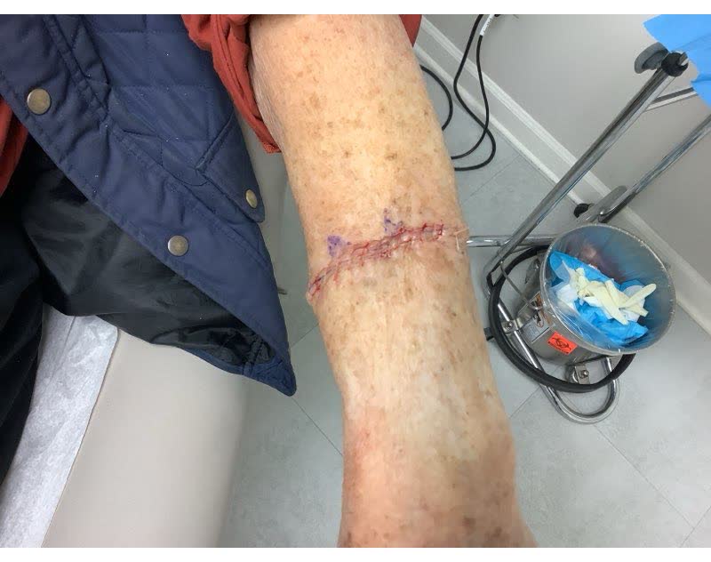 Mohs case 8 — Repair · same day: two infiltrative basal cell carcinomas on the left forearm