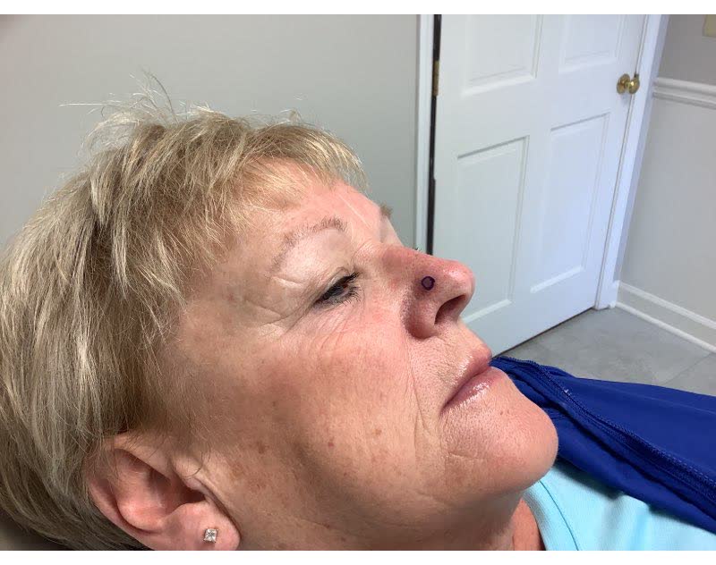 Mohs case 9 — Before: basal cell carcinoma on the nasal sidewall