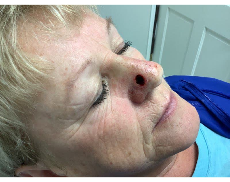 Mohs case 9 — After cancer removal: basal cell carcinoma on the nasal sidewall