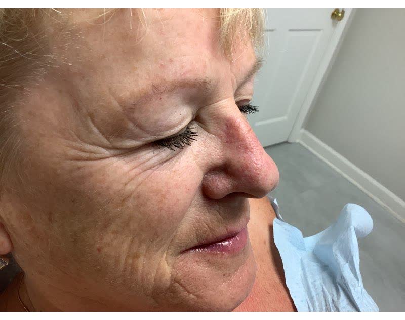 Mohs case 9 — Healed: basal cell carcinoma on the nasal sidewall