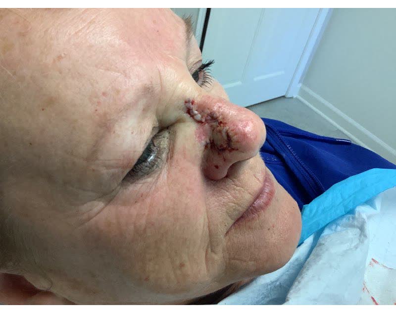 Mohs case 9 — Repair · same day: basal cell carcinoma on the nasal sidewall