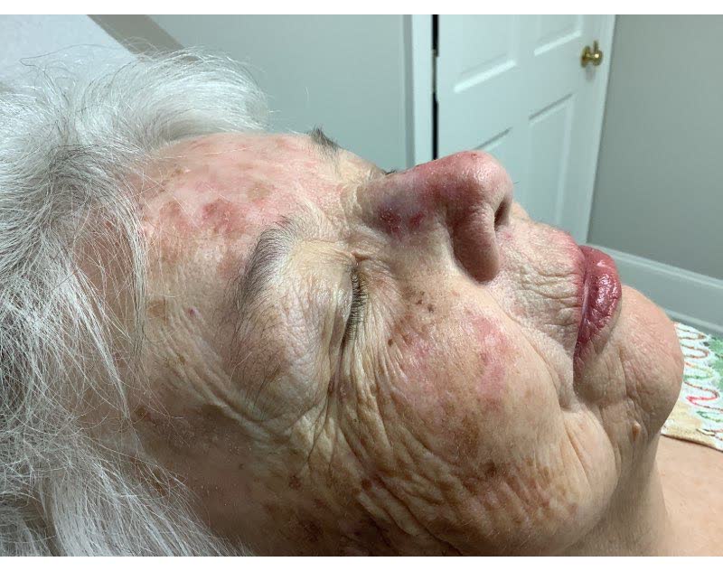 Mohs case 10 — Before: squamous cell carcinoma on the nose