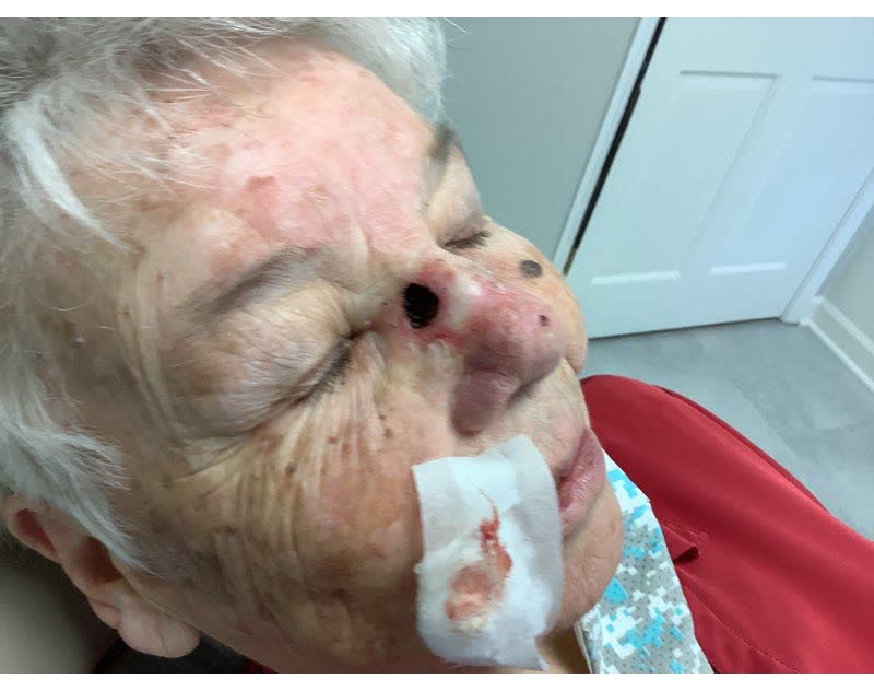 Mohs case 10 — After cancer removal: squamous cell carcinoma on the nose