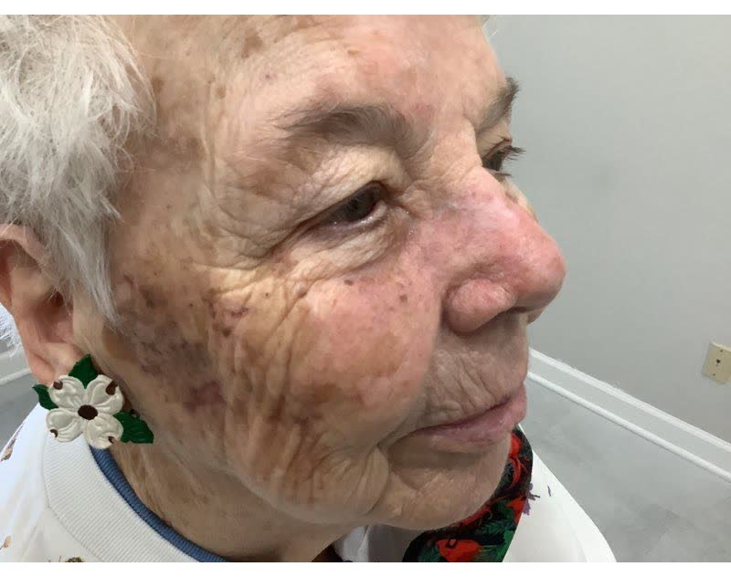 Mohs case 10 — Healed: squamous cell carcinoma on the nose