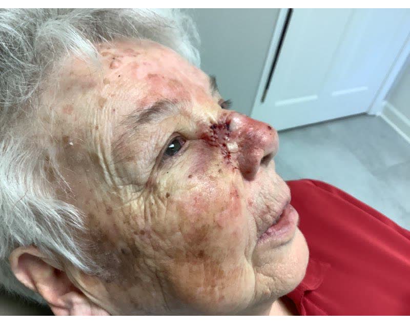 Mohs case 10 — Repair · same day: squamous cell carcinoma on the nose