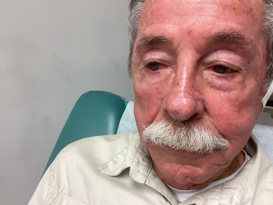 Mohs case 11 — Healed: infiltrative basal cell carcinoma on the nose