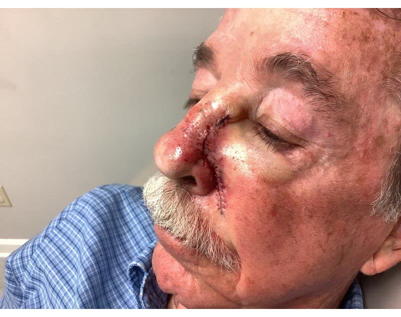Mohs case 11 — Repair · same day: infiltrative basal cell carcinoma on the nose