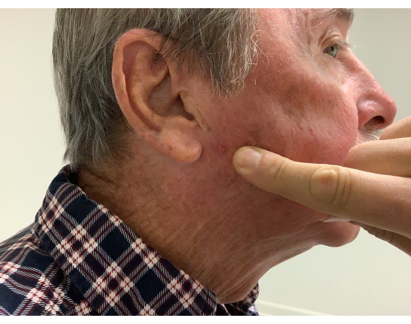 Mohs case 12 — Before: infiltrative basal cell carcinoma on the right cheek
