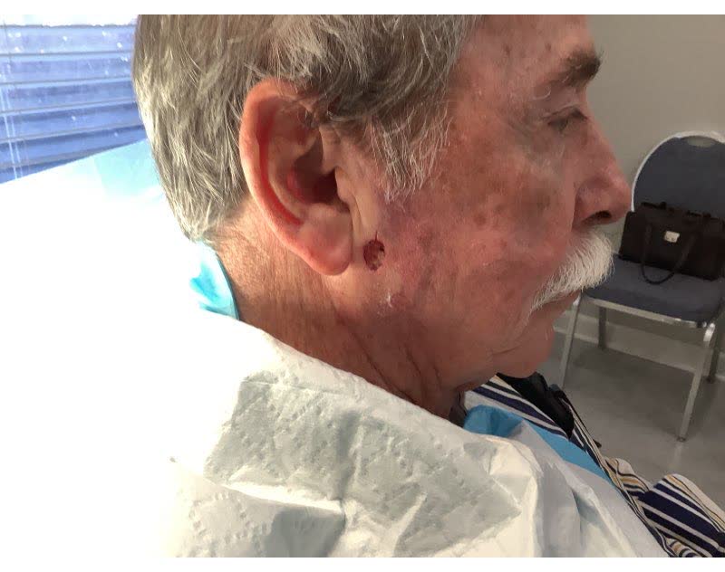 Mohs case 12 — After cancer removal: infiltrative basal cell carcinoma on the right cheek