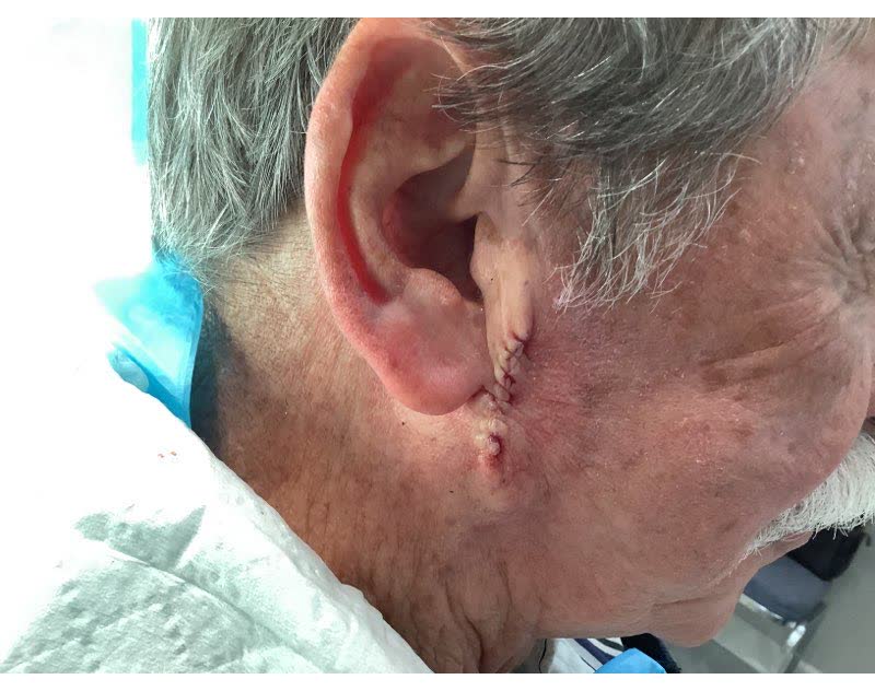 Mohs case 12 — Repair · same day: infiltrative basal cell carcinoma on the right cheek