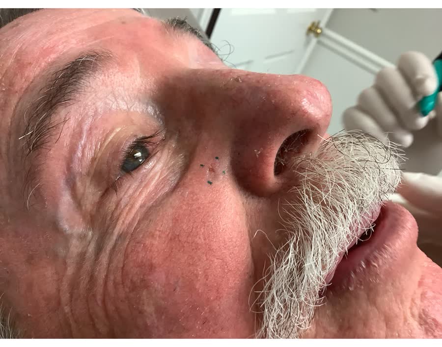 Mohs case 13 — Before: basal cell carcinoma on the right cheek near the nose