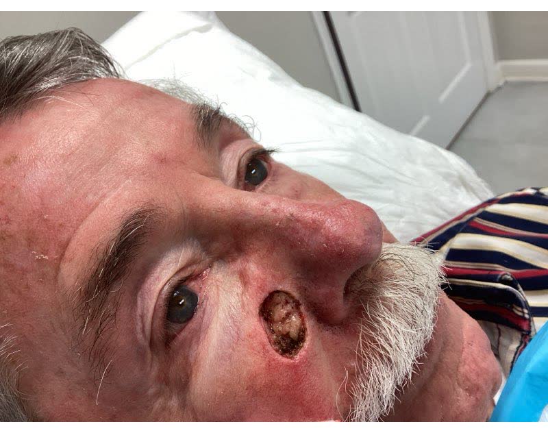 Mohs case 13 — After cancer removal: basal cell carcinoma on the right cheek near the nose