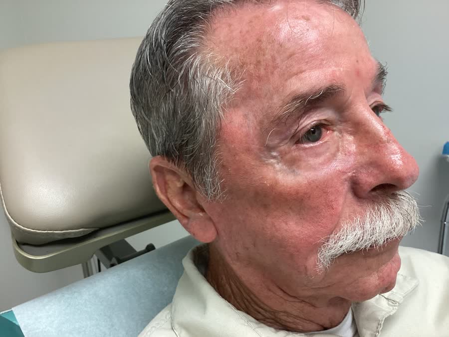 Mohs case 13 — Healed: basal cell carcinoma on the right cheek near the nose