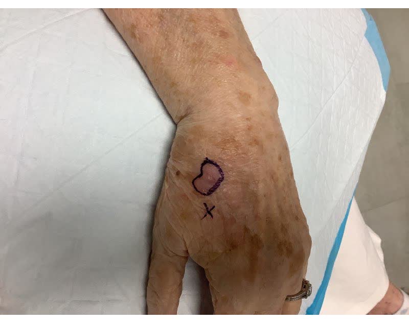 Mohs case 14 — Before: squamous cell carcinoma on the left hand
