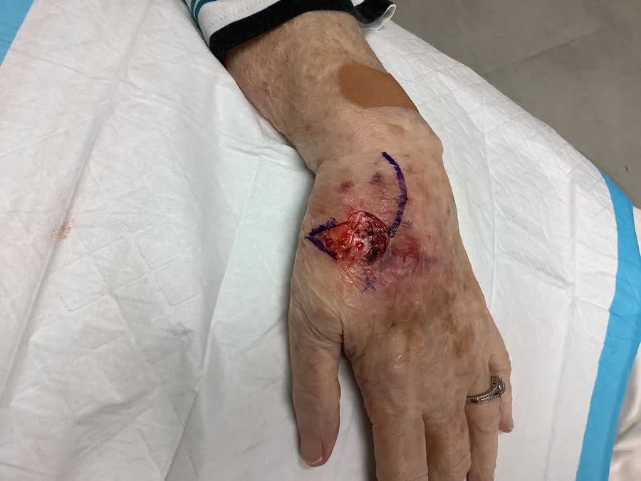 Mohs case 14 — After cancer removal: squamous cell carcinoma on the left hand