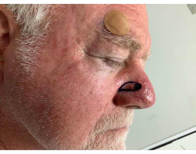 Mohs case 15 — Before - close-up: basal cell carcinoma on the nasal dorsum
