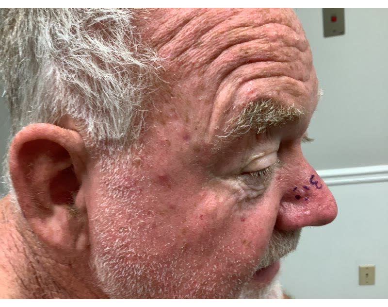 Mohs case 15 — Before: basal cell carcinoma on the nasal dorsum