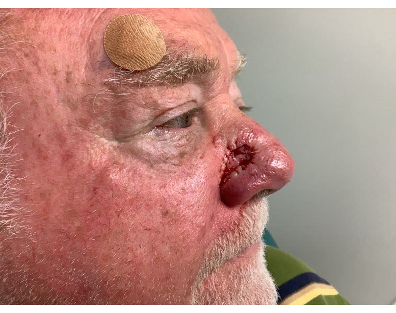 Mohs case 15 — After cancer removal: basal cell carcinoma on the nasal dorsum