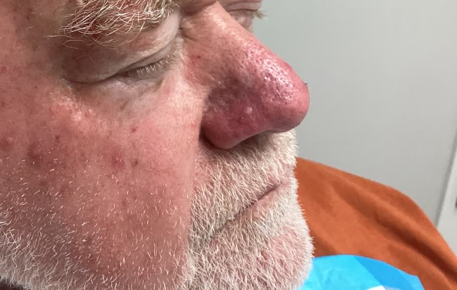 Mohs case 15 — Healed: basal cell carcinoma on the nasal dorsum