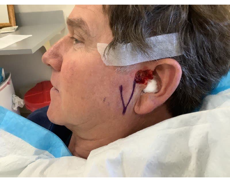 Mohs case 16 — After cancer removal: basal cell carcinoma on the left ear and sideburn