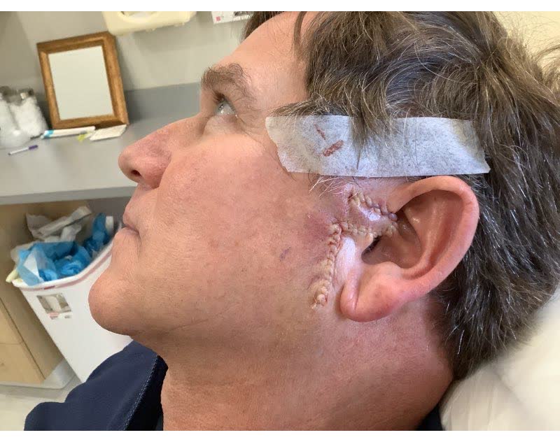 Mohs case 16 — Repair · same day: basal cell carcinoma on the left ear and sideburn