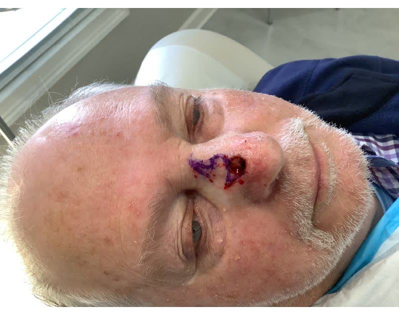 Mohs case 17 — After cancer removal: infiltrative basal cell carcinoma on the nose