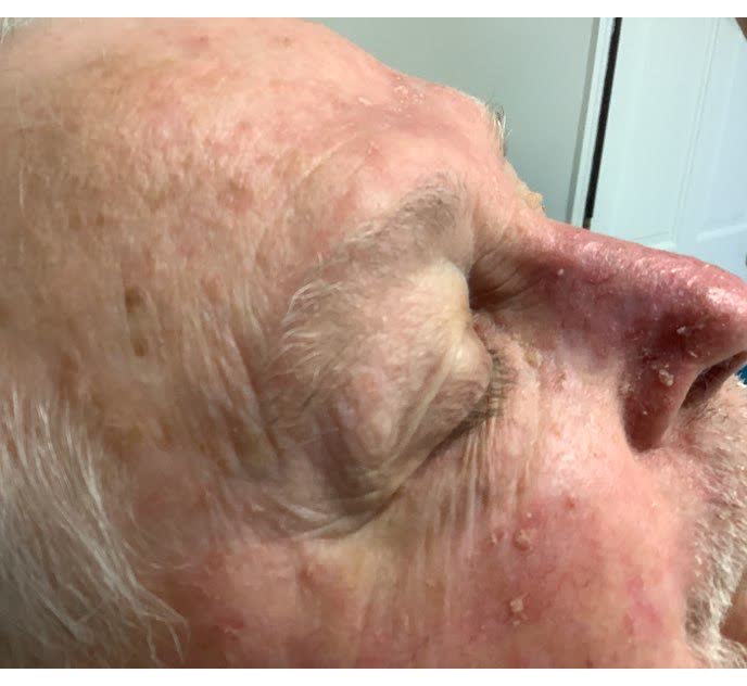 Mohs case 17 — Healed: infiltrative basal cell carcinoma on the nose