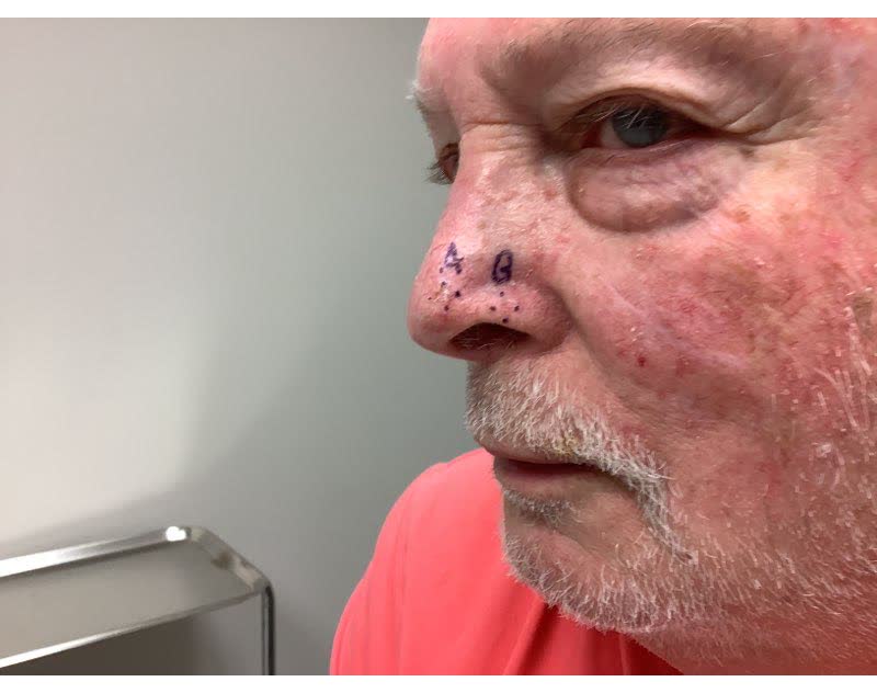 Mohs case 18 — Before: two basal cell carcinomas on the nose, including the alar rim