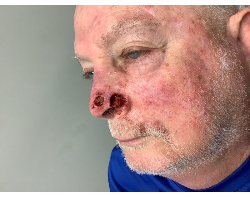 Mohs case 18 — After cancer removal: two basal cell carcinomas on the nose, including the alar rim
