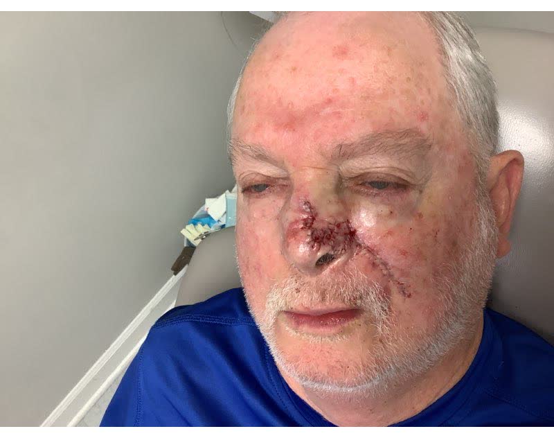 Mohs case 18 — Repair · same day: two basal cell carcinomas on the nose, including the alar rim